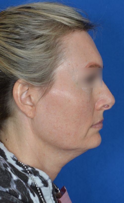 mini facelift before and after