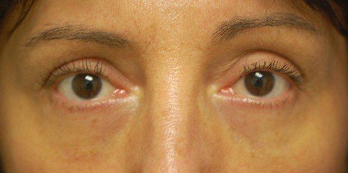 after teartrough plastic surgery