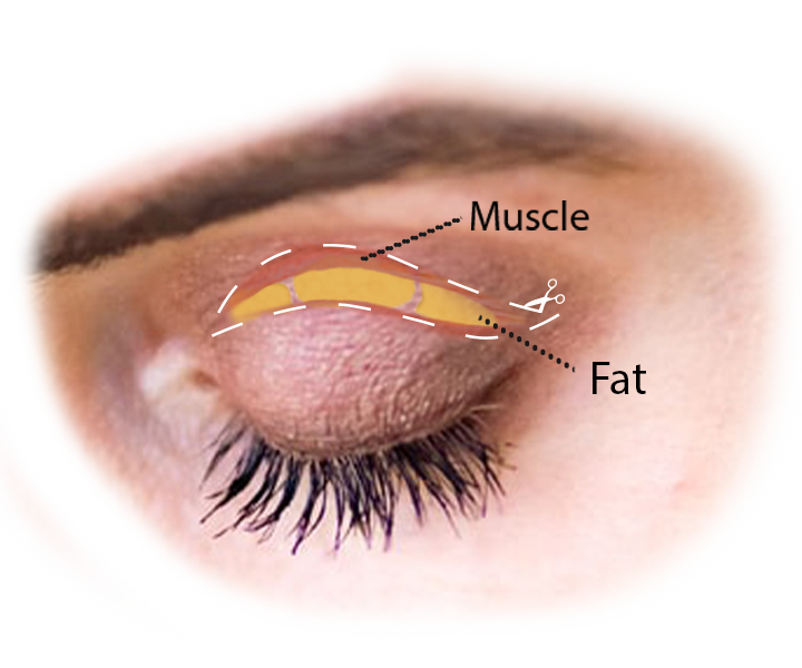 graphic of upper eyelid surgery