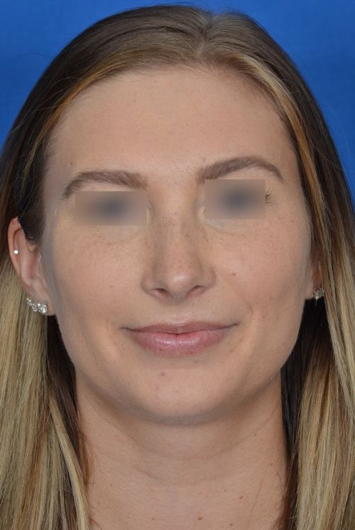 female rhinoplasty