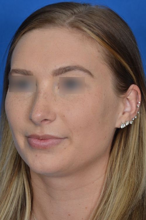 female rhinoplasty