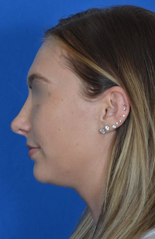 female rhinoplasty