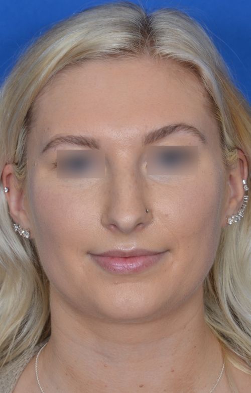 before rhinoplasty