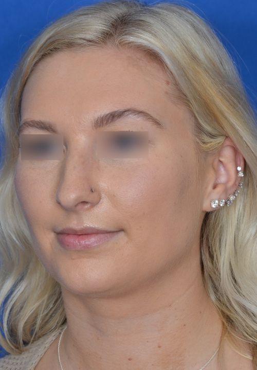 before rhinoplasty