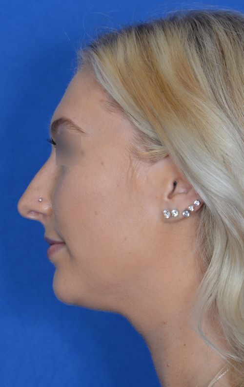before rhinoplasty
