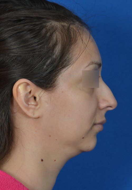 female chin implant example