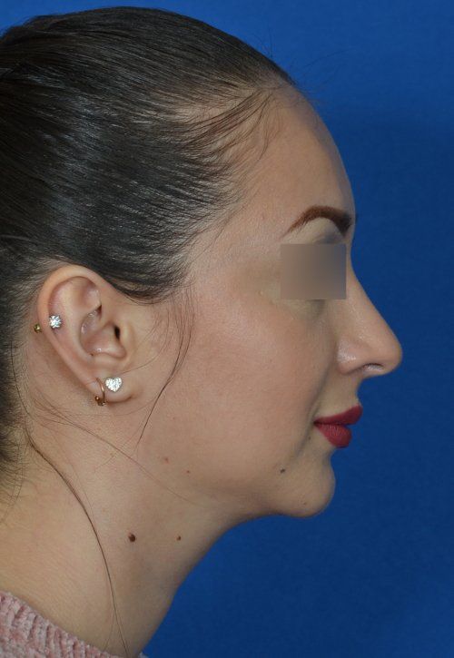 female chin implant example