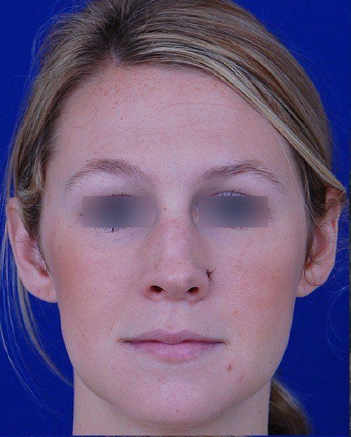 female rhinoplasty