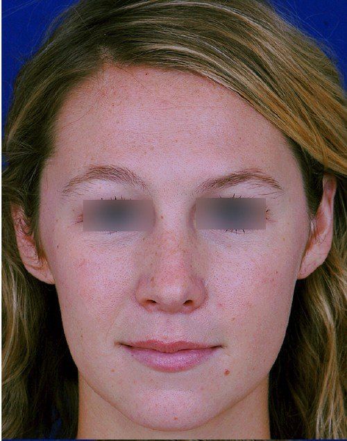female rhinoplasty