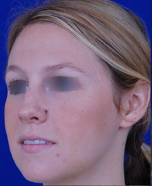 female rhinoplasty