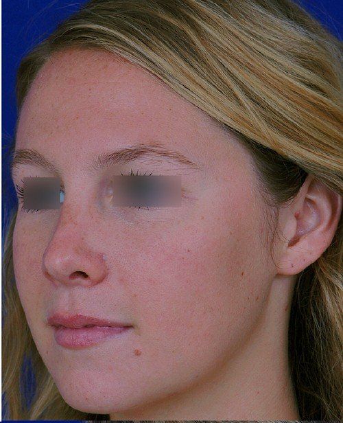 female rhinoplasty