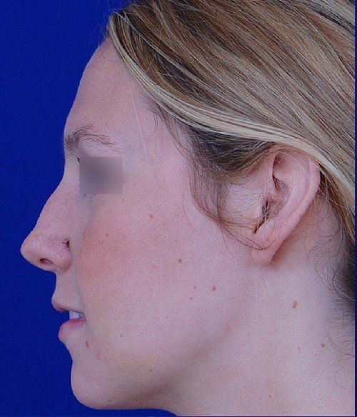 female rhinoplasty
