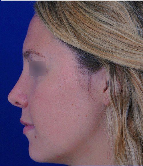 female rhinoplasty