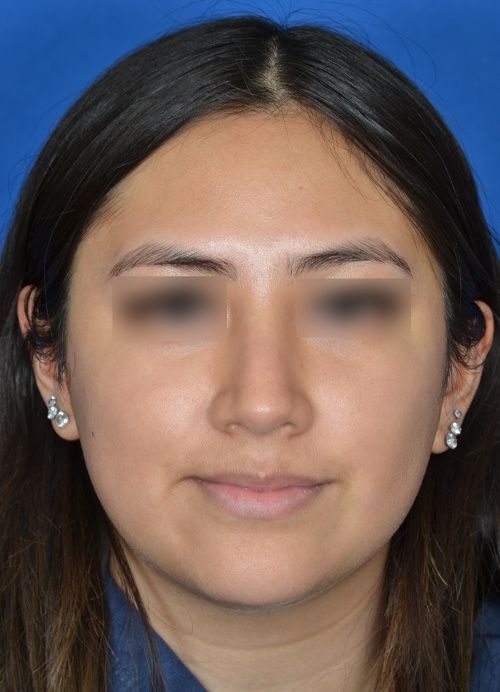 female rhinoplasty
