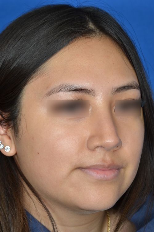 female rhinoplasty
