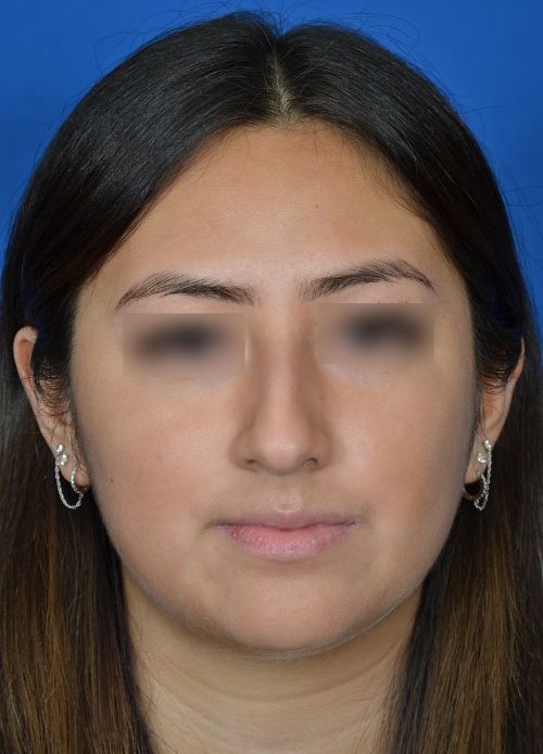 before rhinoplasty