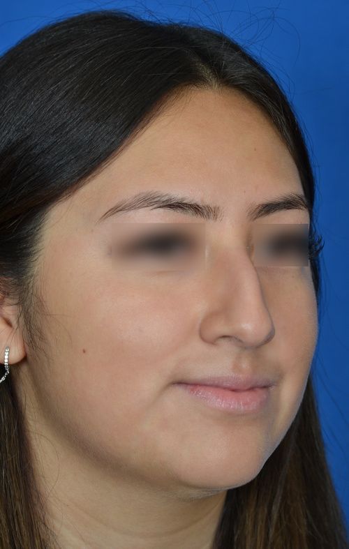 before rhinoplasty