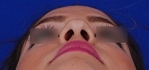 rhinoplasty before and after