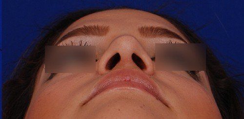 rhinoplasty before and after