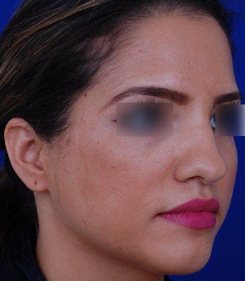 rhinoplasty