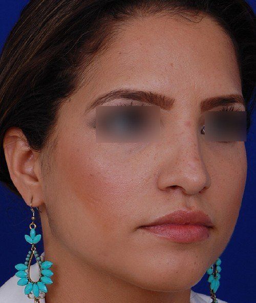 rhinoplasty