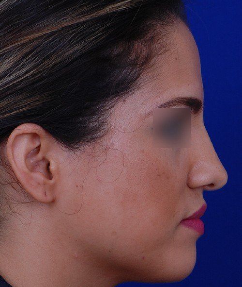 rhinoplasty