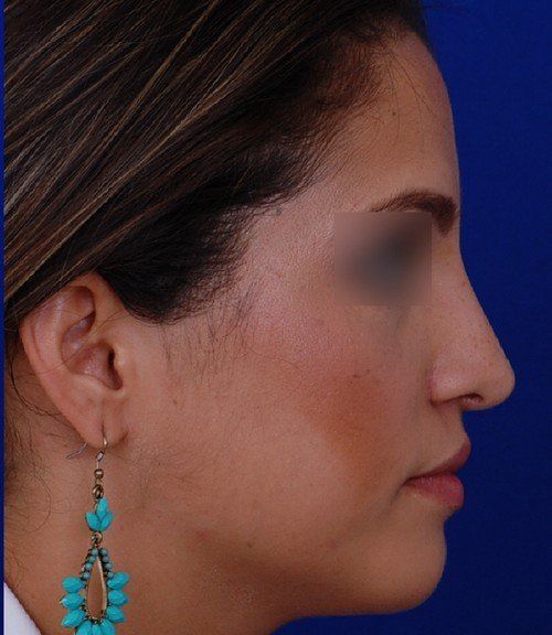 rhinoplasty