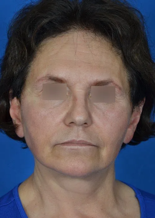mini facelift before and after