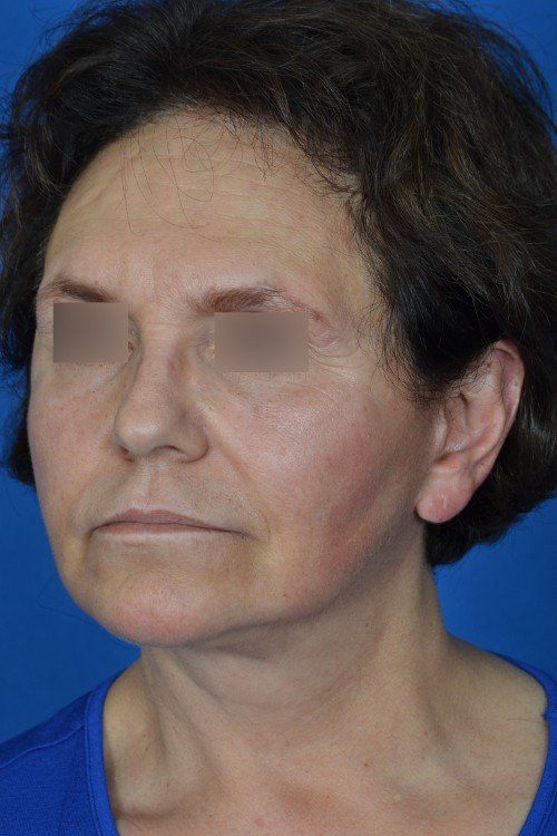 mini facelift before and after