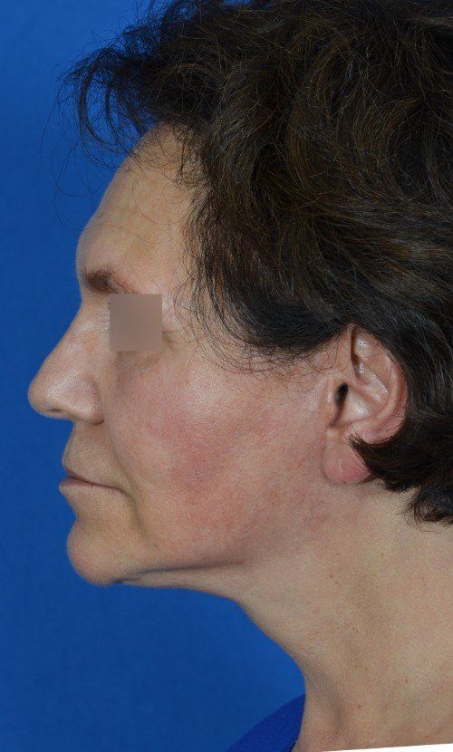 mini facelift before and after
