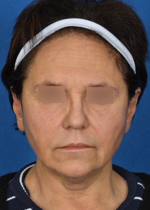 mini facelift before and after