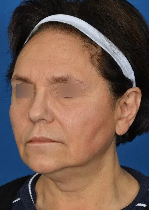 mini facelift before and after