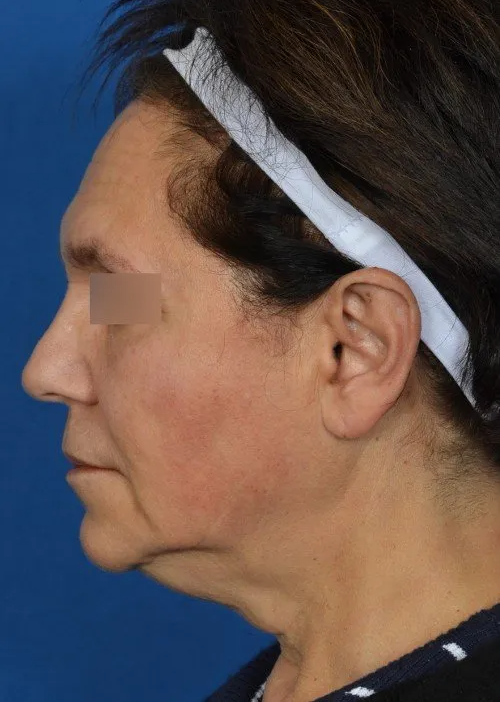 mini facelift before and after