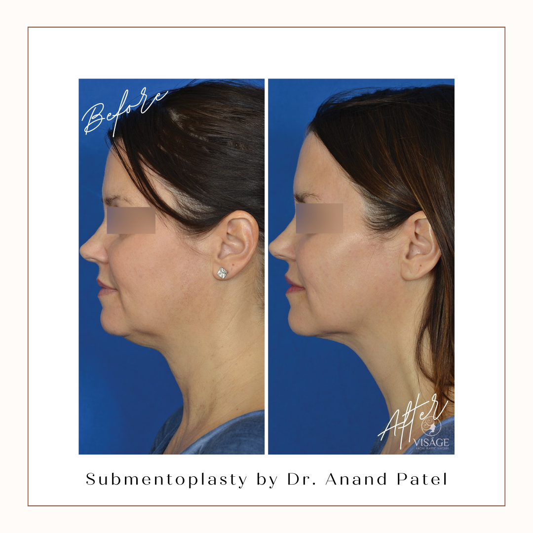 submentoplasty before and after submentoplasty before and after