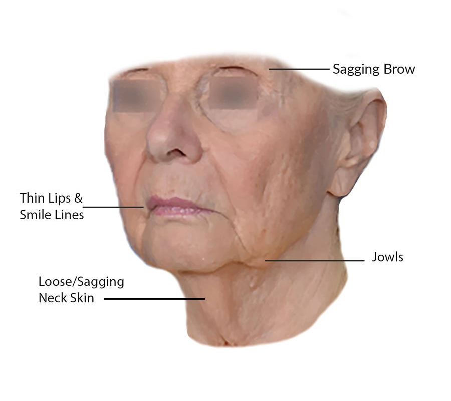 old womans face with lines pointing to jowls, sagging brow and smile lines