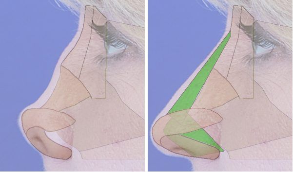 revision rhinoplasty schematic