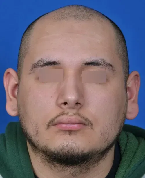 male before otoplasty
