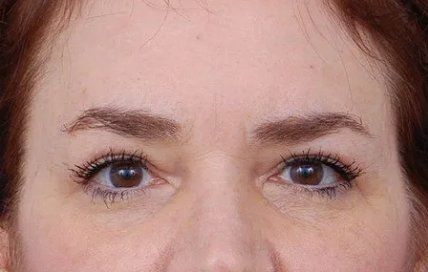 woman after brow lift