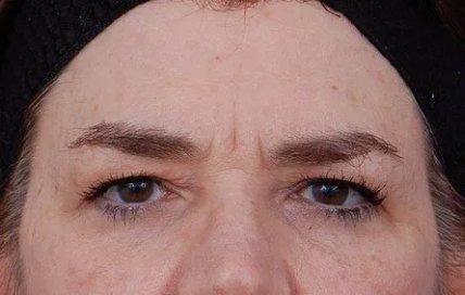 woman before brow lift