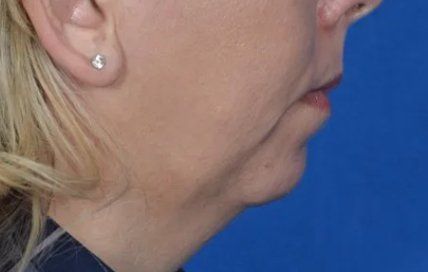 woman before chin implant