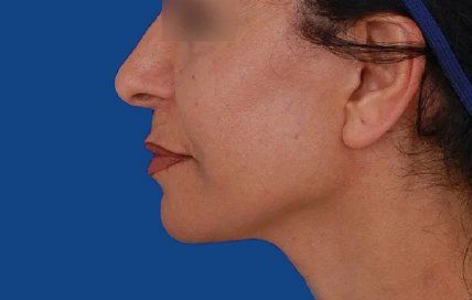 neck lif