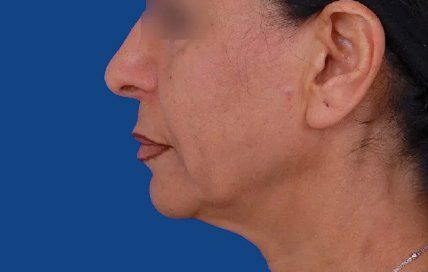 neck lift before