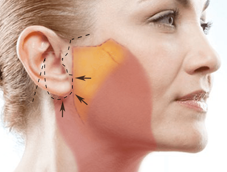 deep plane facelift