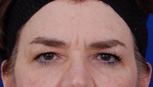 brow lift before and after