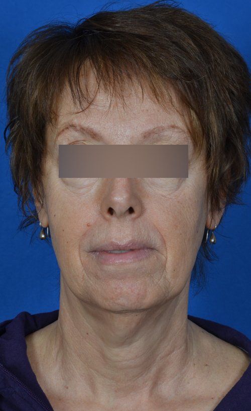 mini facelift before and after