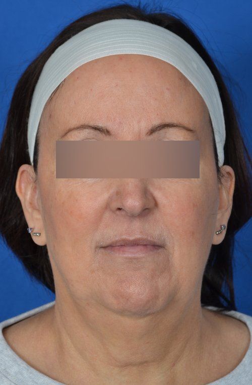 mini facelift before and after
