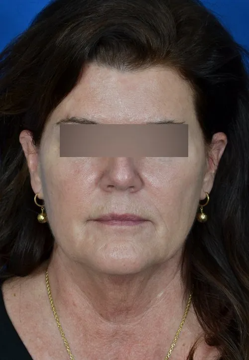 mini facelift before and after