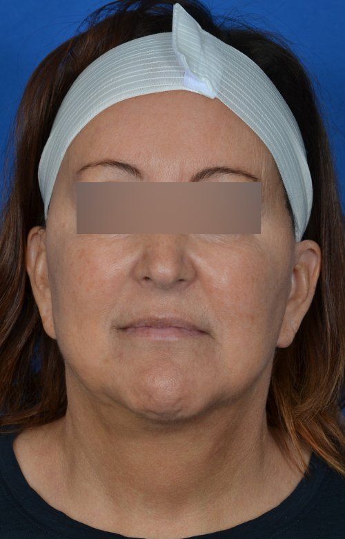 mini facelift before and after
