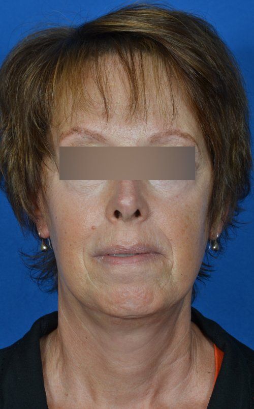 mini facelift before and after