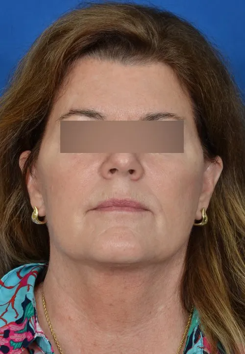 mini facelift before and after